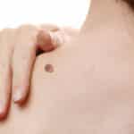 Mujer con una verruga en el cuello